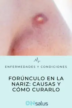 FORÚNCULO en la NARIZ - Causas y CÓMO CURARLO