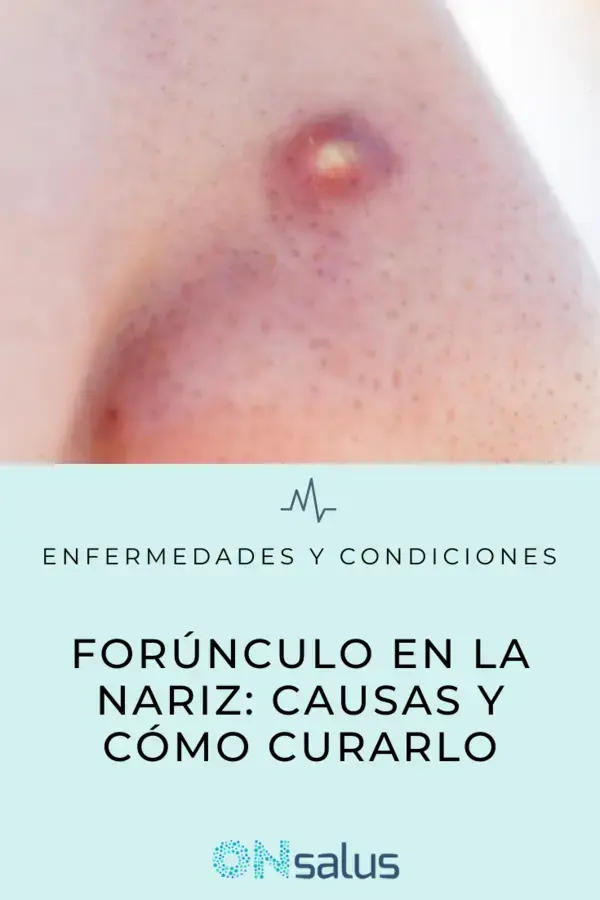 FORÚNCULO en la NARIZ - Causas y CÓMO CURARLO