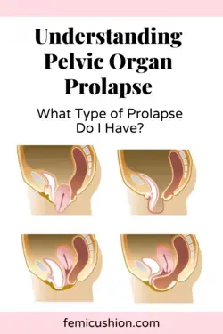 What Kind of Pelvic Organ Prolapse Do I have? | Different types of Prolapse | FemiCushion