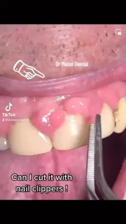 Teeth Cleaning, Teeth Whitening Hack, Oral Hygiene, Whiten Teeth at Home, Improve Oral Health