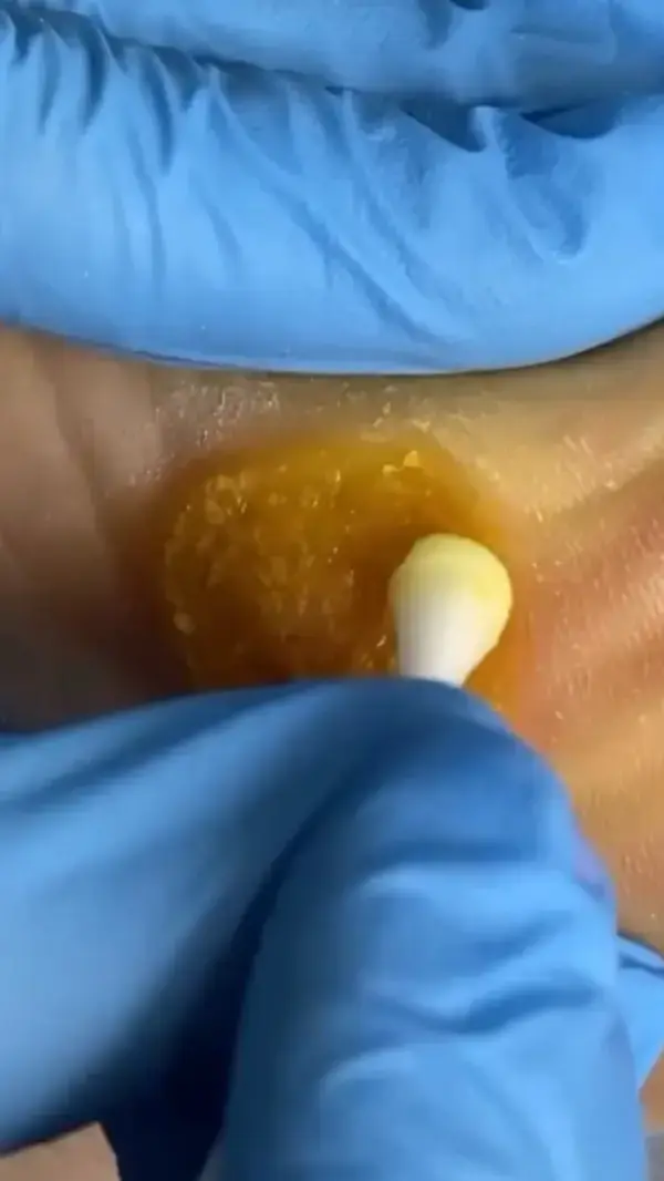 Biggest wart ever seen 😯 #warts #wartstreatment #wartsremoval #podology