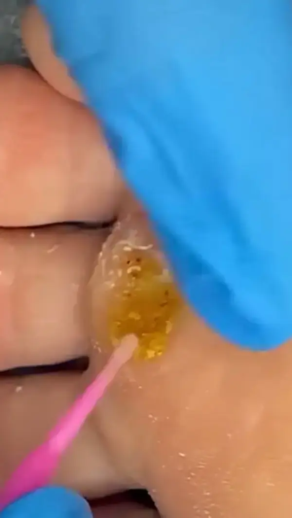 Multiple warts removal 😱