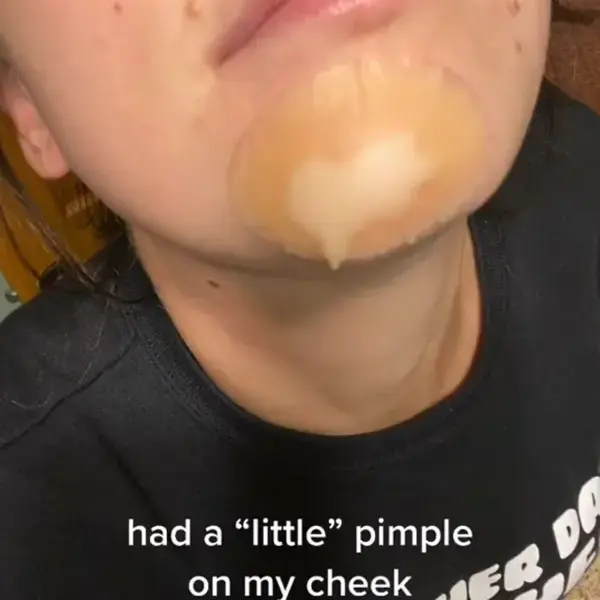 PIMPLE POPPING TUTORIAL