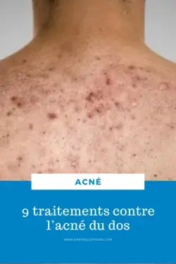 9 traitements contre l’acné du dos