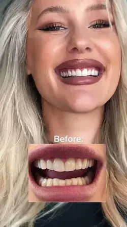 How do I whiten my teeth?