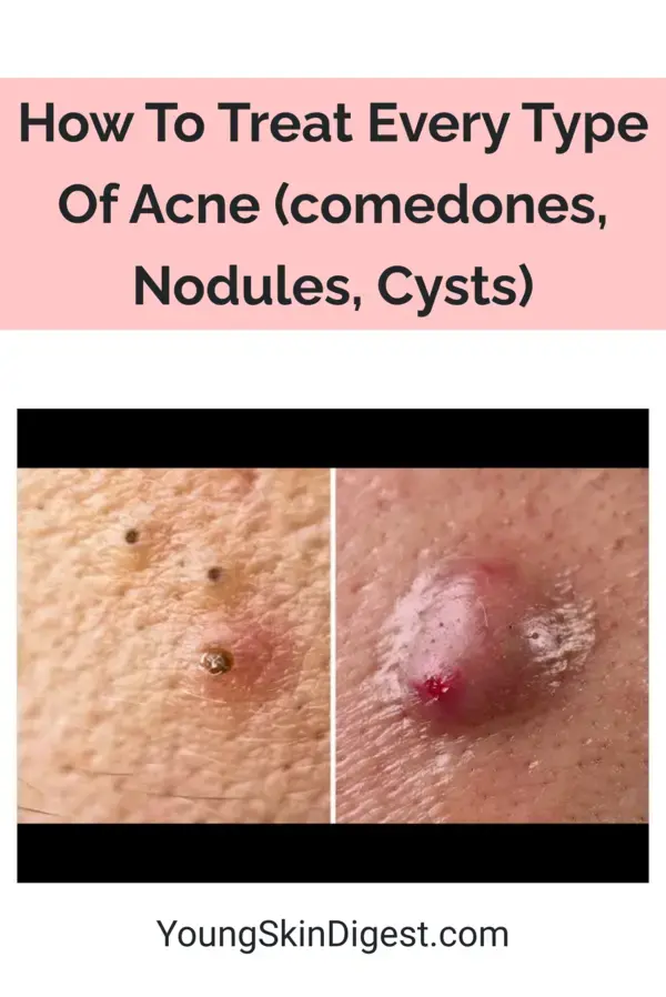 How To Treat Every Type Of Acne (comedones, Nodules, Cysts)