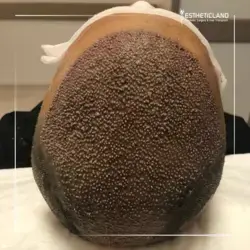 Hair Transplant