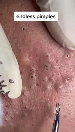 Blackhead removal