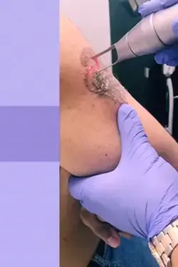 Laser Tattoo Removal NYC