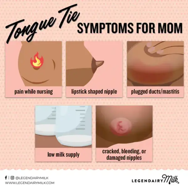 Tongue Tie and Breastfeeding