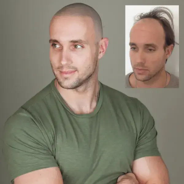 Is hair tattoos and scalp micropigmentation the same thing?