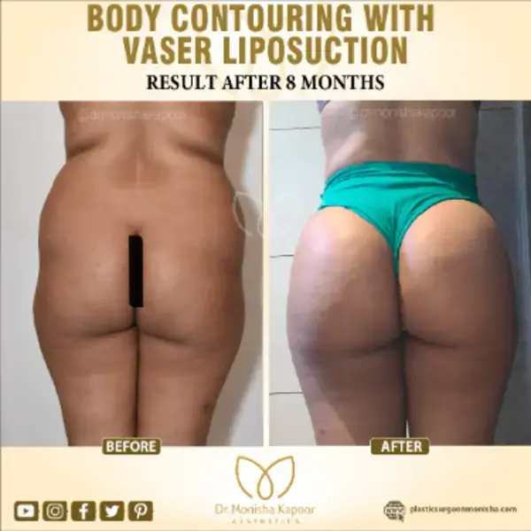 Body Contouring With Vaser Liposuction in India